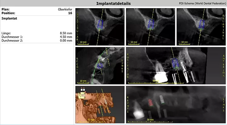 Abb. 4: Implantatplanung regio 16.