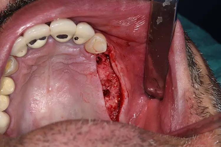 Abb. 29: Aufbereitete Implantatlager regio 24 und 26.