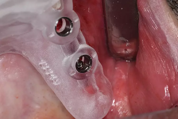 Abb. 30: Kontrolle der inserierten Implantate regio 24 und 26.
