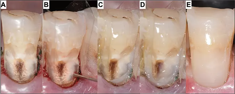 Abb. 4: Füllen mit der sogenannten Zürcher Tropfentechnik: Nach Exkavation und Trockenlegung (A) wird mit transparenten Matrizen das Nachbarzahnareal geschützt und mit einem fließfähigen Kompositmaterial schrittweise tropfen- und linienartig gezielt in kleinen Inkrementen aufgetragen. Diese Portionen werden sofort polymerisiert und die Schritte so lange wiederholt, bis der Randbereich für die kommenden Inkremente aufgebaut und abgedichtet wurde (B-E).