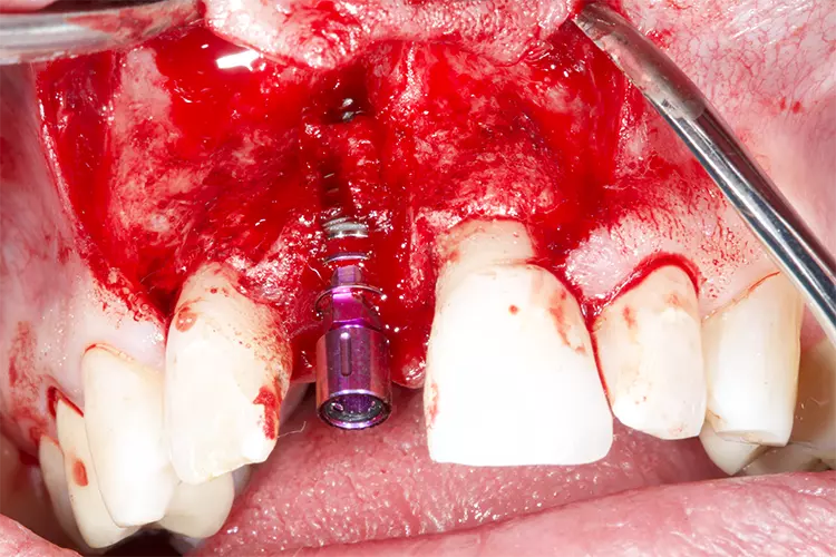 Abb. 4: Situation nach Implantatinsertion eines Camlog Progressive Line 4,3 x 11 mm.