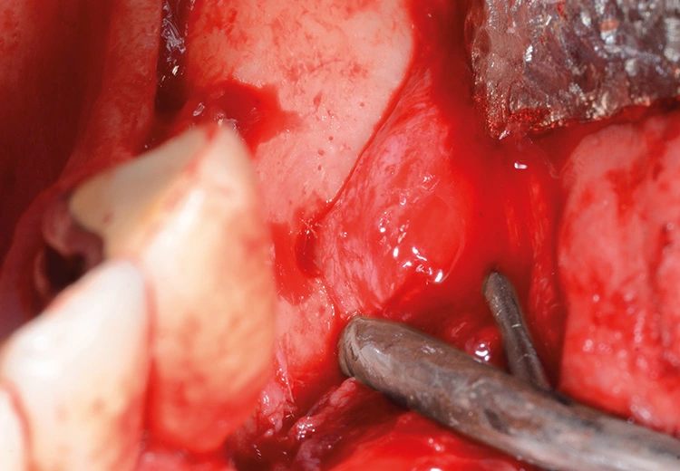 Abb. 4: Nach crestaler Schnittführung, vestibulärer und lingualer Abpräparation, vestibulärer Entlastung und Freipräparation des N. mentalis erfolgt die Periostschlitzung vestibulär.