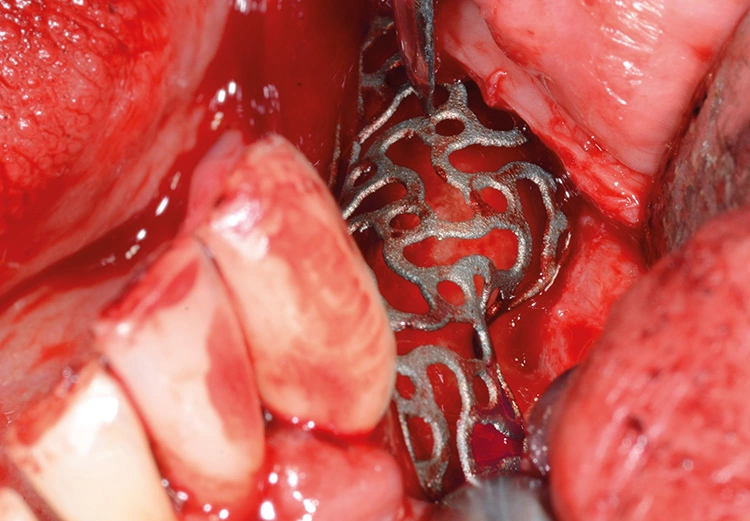 Abb. 5: Konditionierung des zu augmentierenden Bereiches mit einem Knochenschaber und kortikalen Bohrungen; Anprobe des passgenauen Gitters.