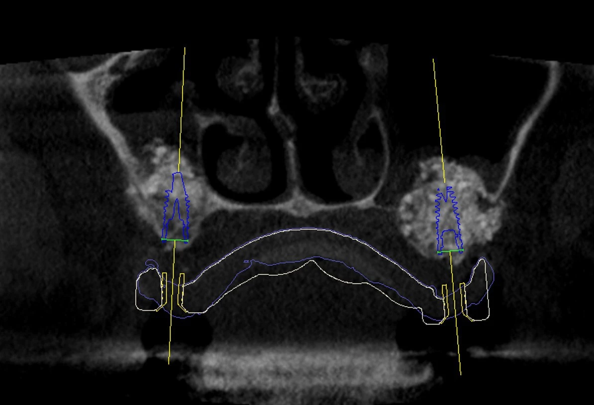 Abb. 5: Implantatplanung im zahnlosen Oberkiefer. Lila Linie: eingescannte Prothese, weiße Linie: geplante Bohrschablone.