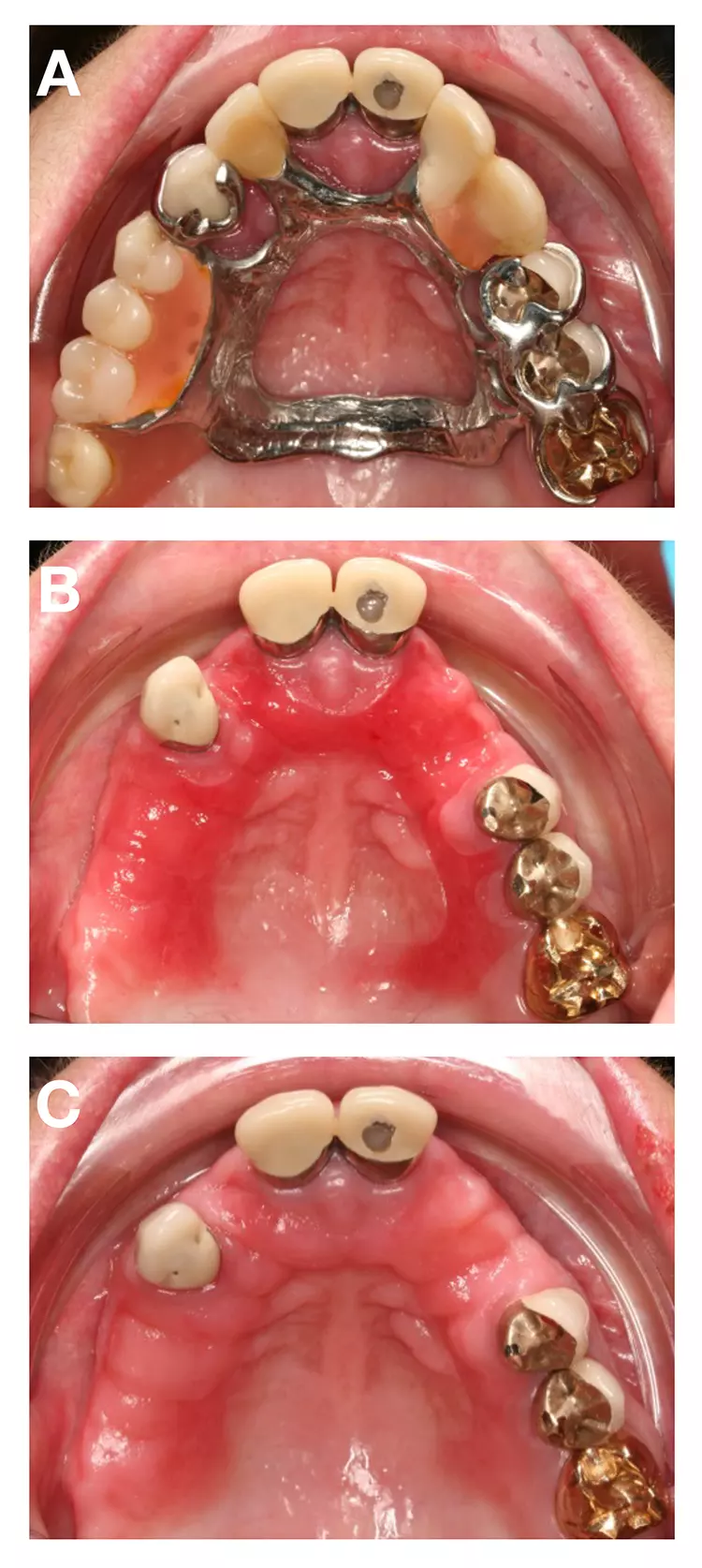 Abb. 5: Klinisches Beispiel für einen relevanten plaquebedingten Befund: Patientin mit Prothesenstomatitis, die sich als HZ-kongruente Rötung des Gaumens manifestierte (A,B) und nach Abklingen durch konsekutive antibakterielle und antimykotische Therapie mit Chlorhexidin-Mundspülung (0,2%) und Amphotericin B für jeweils eine Woche (C).