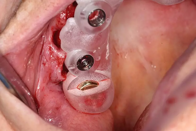 Abb. 6: Eingesetzte Bohrschablone mit Aussparung 17 mesial zur Überprüfung
des exakten Sitzes.