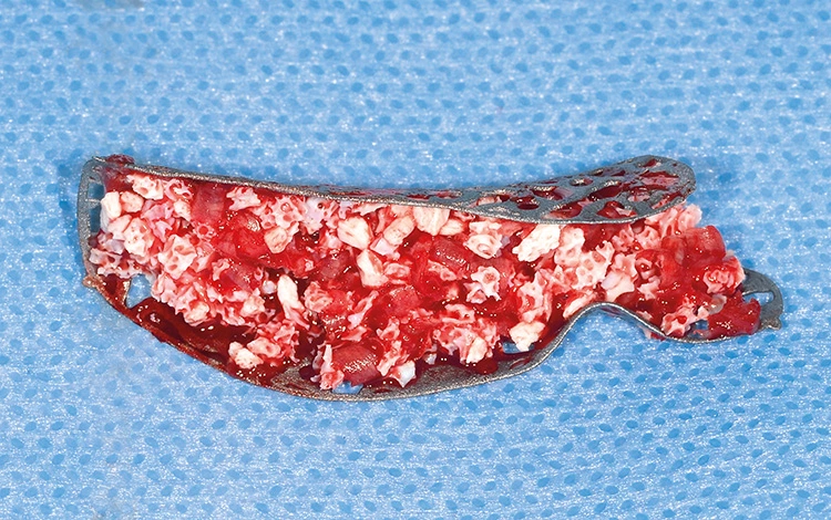 Abb. 6: Der gewonnene autologe Knochen wurde mit Geistlich Bio-Oss® gemischt, das Gitter damit aufgefüllt und eingesetzt.