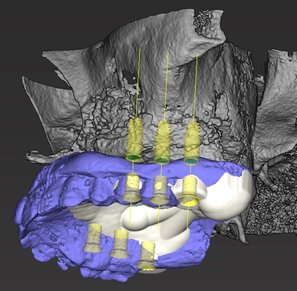 Abb. 6: 3D-Rekonstruktion. Schleimhautgetragene Bohrschablone abgestützt am Gaumen und am Tuber maxillae.