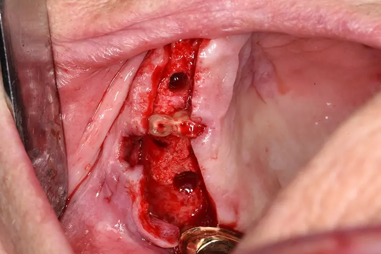 Abb. 7: Aufbereitetes Implantatbett regio 14 und 16. Der Zahn 14 wird im weiteren
Verlauf noch extrahiert.