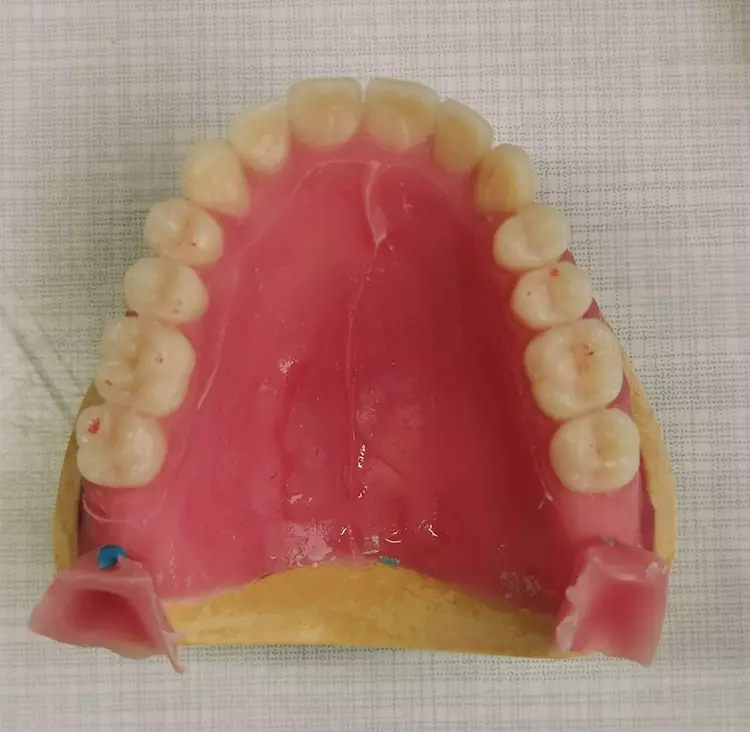 Abb. 7: Die bereits in Kunststoff gegossene Oberkieferprothese.