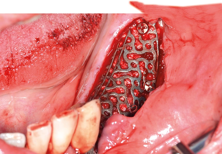 Abb. 7: Fixierung des aufgefüllten Gitters mit Osteosyntheseschrauben.