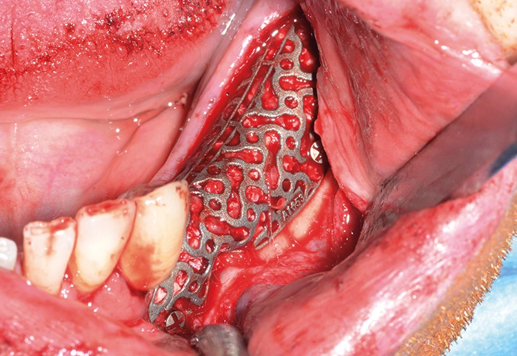 Abb. 8: Ansicht des eingesetzten Yxoss CBR® Gitters.