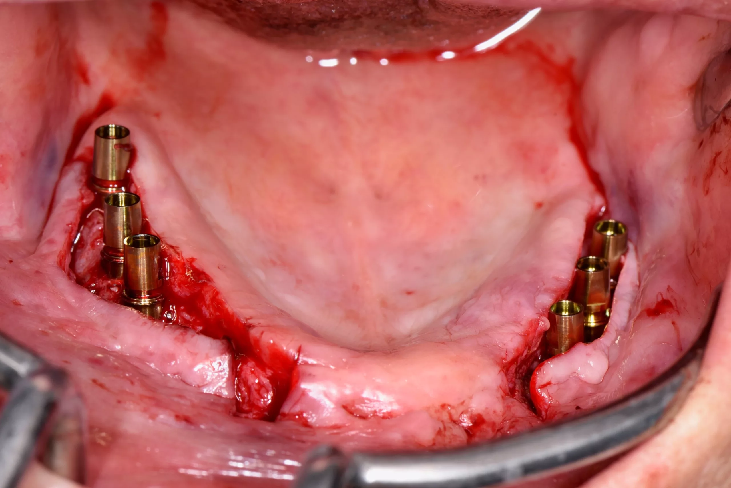 Abb. 8: Inserierte Implantate.
