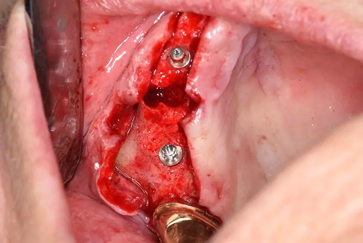 Abb. 9: Inserierte Implantate regio 14 und 16 und die Extraktionsalveole regio 15.