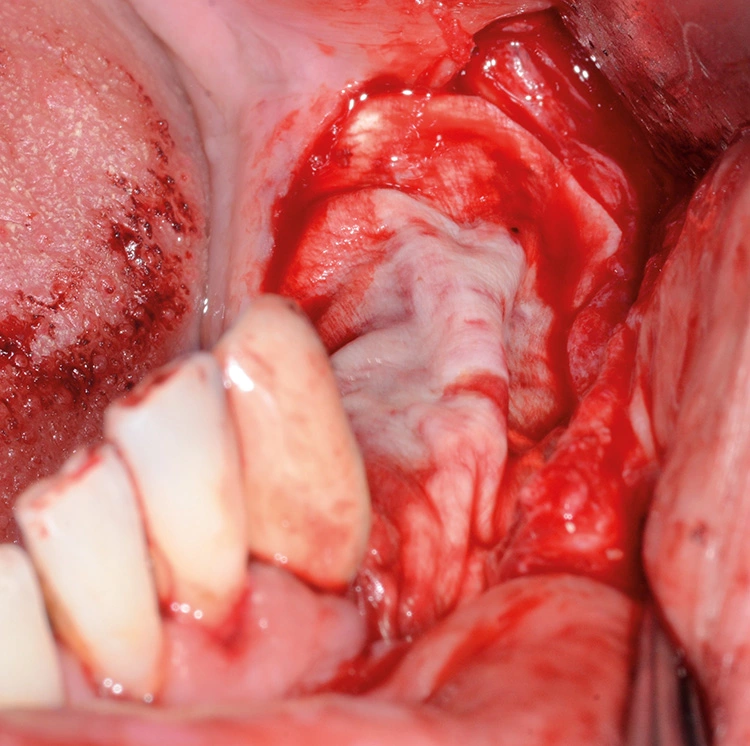 Abb. 9: Abdeckung des Gitters mit der GBR-Membran Geistlich Bio-Gide®.