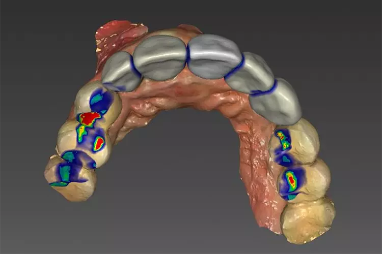 Das neue Keramikhandbuch wurde erheblich erweitert, u.a. mit Kapiteln zur Digitalisierung der Behandlung, zur Implantatprothetik und Keramikimplantaten. Hier Justierung okklusaler Kontakte für eine implantatgetragene Brücke.