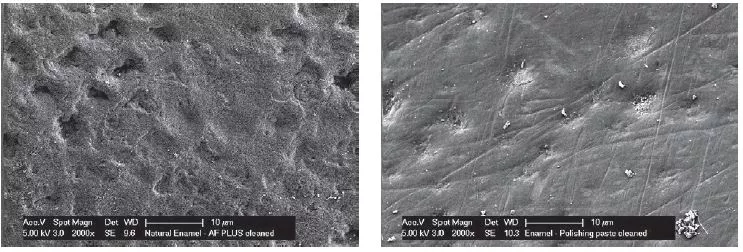 Abb. 2: Links die Zahnoberfläche nach der Behandlung mit AIR-FLOW® PLUS: Die Reinigung erfolgte bis in die Vertiefungen der Schmelzmikrostruktur; rechts nach der Behandlung mittels klassischer Politur sind noch Polierpasten- und Biofilmreste sichtbar.
