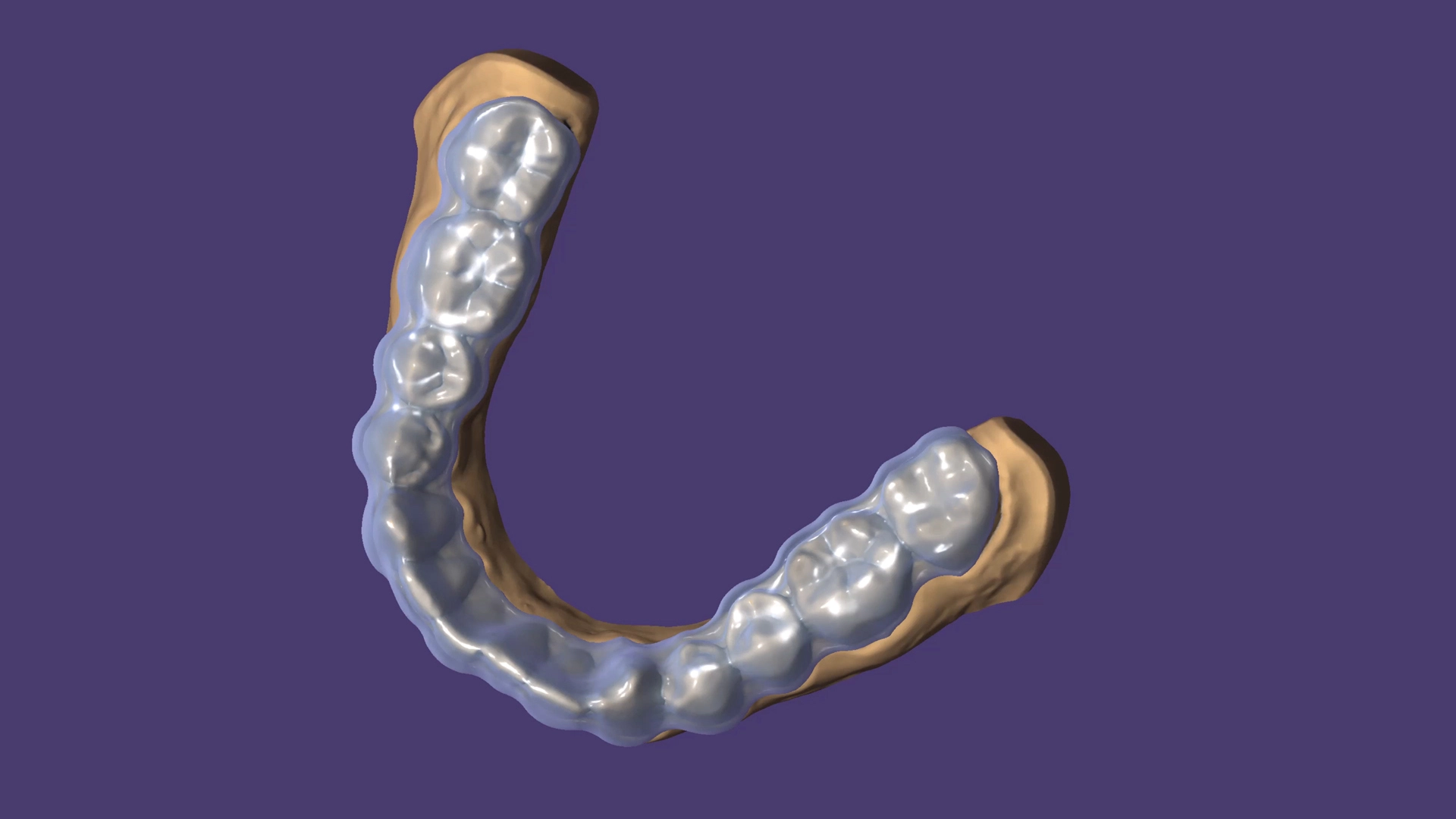 Mit dem Bite Splint Modul genießen Anwender mehr Automatisierung beim Design von Aufbissschienen.
