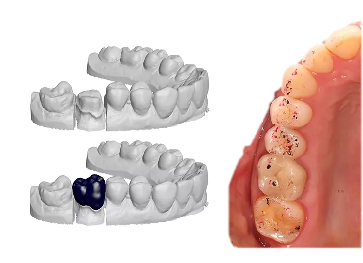 Computergestütztes Design und klinisches Bild beim 1-Jahres-Recall einer Studienkrone aus Lithiumdisilikatkeramik.