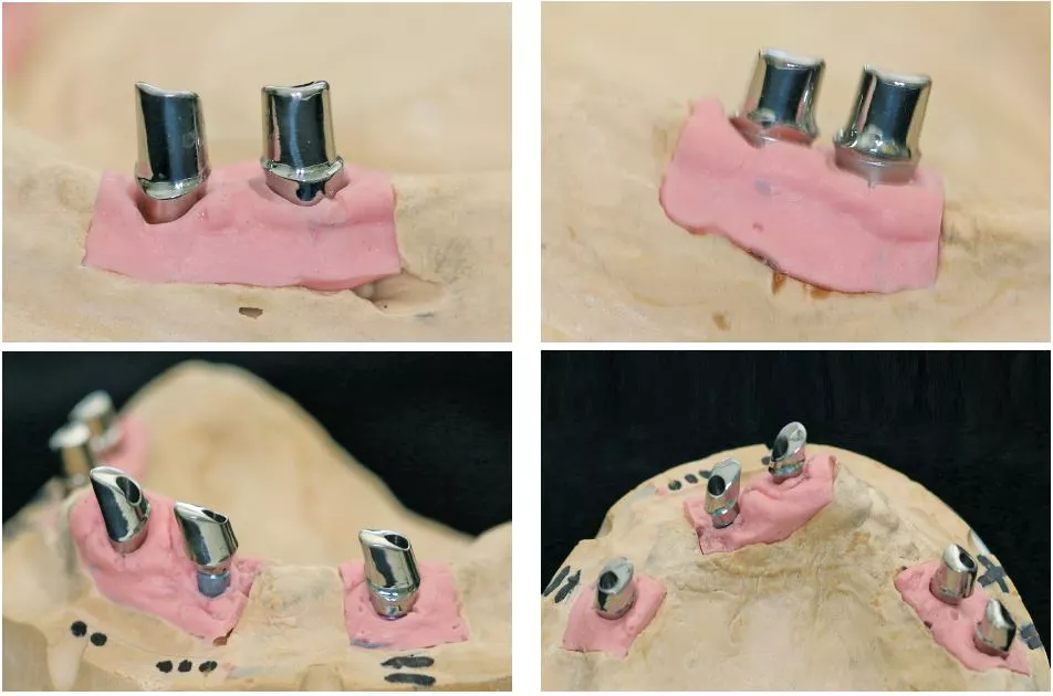 Abb. 10a–d: Fertig gefräste und auf Hochglanz polierte Titan-Abutments.