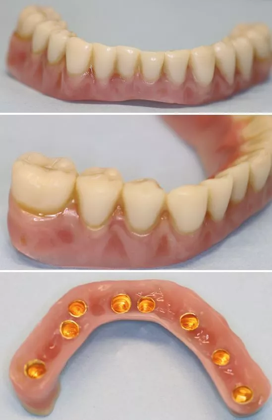 Abb. 4a–c: Seit 11 Jahren im Mund und ohne Korrosion: Galvano-Teleskopprothese auf Titan-Abutments.