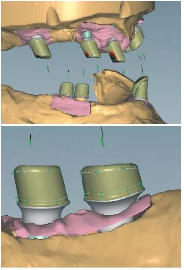 Abb. 9c u. d: Planung der Abutments am PC.