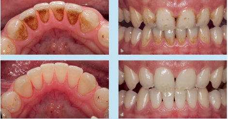 Abb. 5a: Intraorale Aufnahmen der Lingual- und Labialflächen der Frontzähne eines männlichen Patienten vor (a, b) und nach (c, d) Reinigung mit Natriumbicarbonat-Pulver.