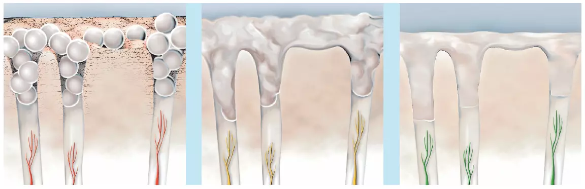 Abb. 4a–c: Wirkungsweise von ACP (Amorphes Calciumphosphat). ACP Kristalle verschließen die Dentinkanälchen, reduzieren so Sensibilitäten und es resultiert eine glatte Zahnoberfläche.