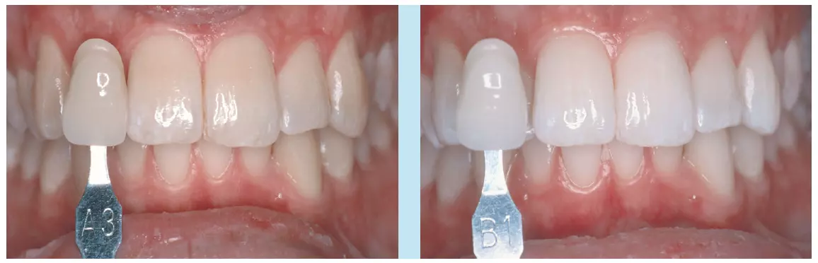 Abb. 5a u. b: Dokumentation vor (a) und nach (b) In-Office-Bleaching.