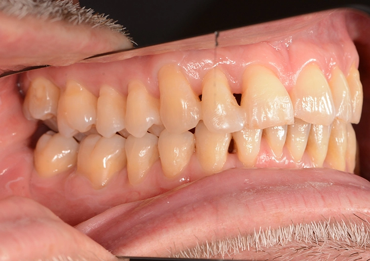 Abb. 3: Fotodokumentation: Zustand nach einem Jahr vor UPT (unterstützende Parodontaltherapie): Das Foto zeigt eine gesunde, rosafarbene, gestippelte Gingiva. Der Patient hat eine adäquate Mundhygiene.