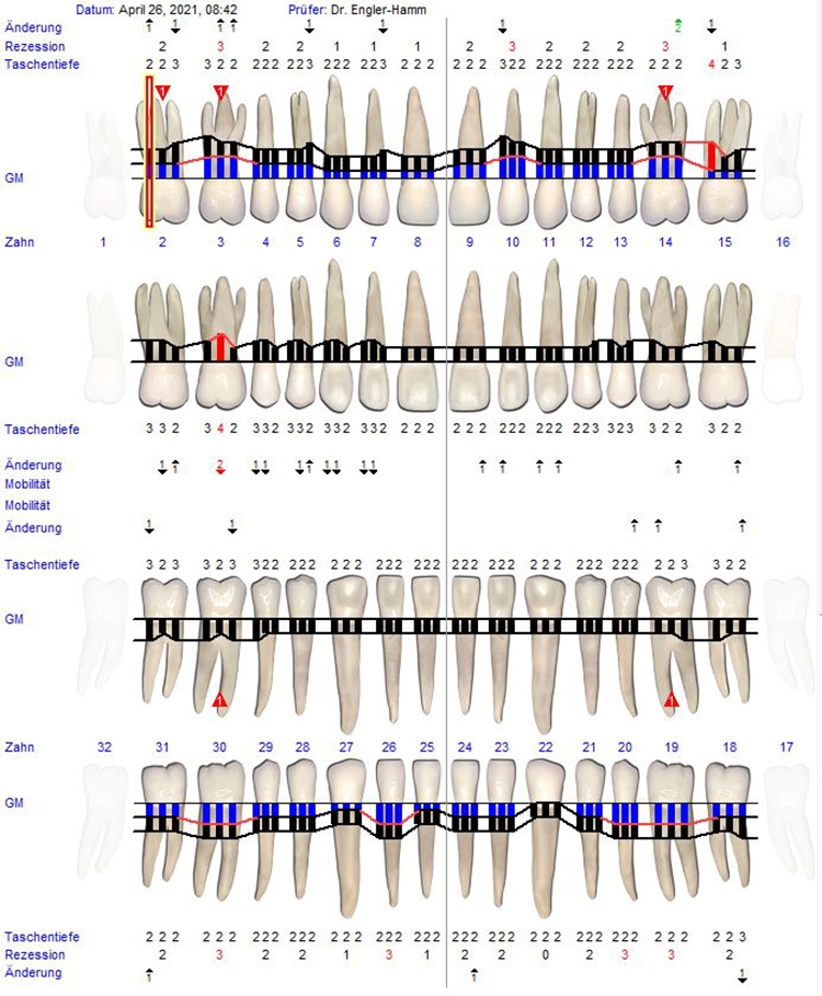 Abb. 5: Reevaluation nach 12 Monaten: Parodontalstatus.