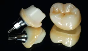 Ti-Base stabilisiertes Hybrid-Abutment mit ausgeformtem Emergenzprofil und individualisierter Implantatkrone aus Lithiumdisilikat.