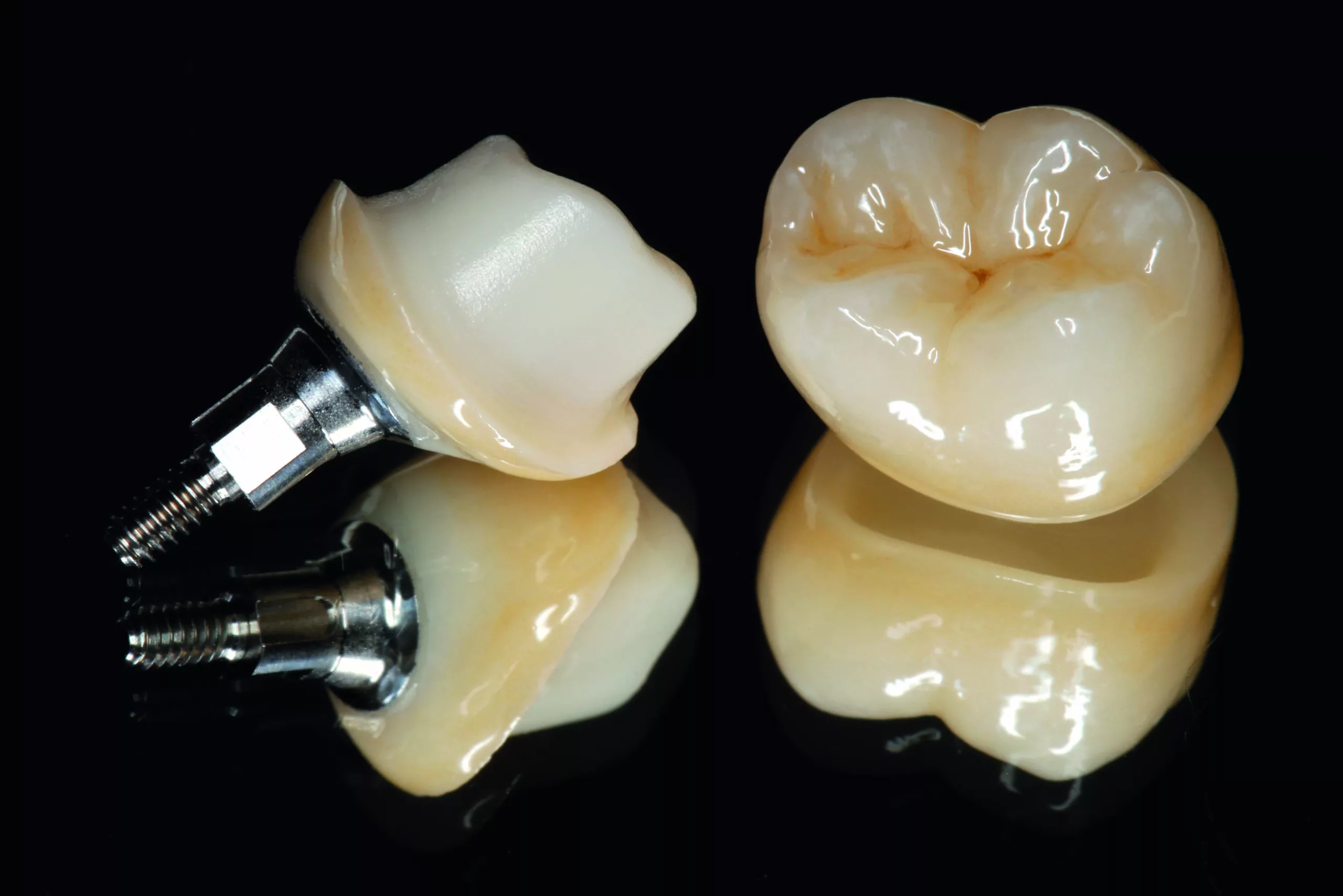 Ti-Base stabilisiertes Hybrid-Abutment mit ausgeformtem Emergenzprofil und individualisierter Implantatkrone aus Lithiumdisilikat.
