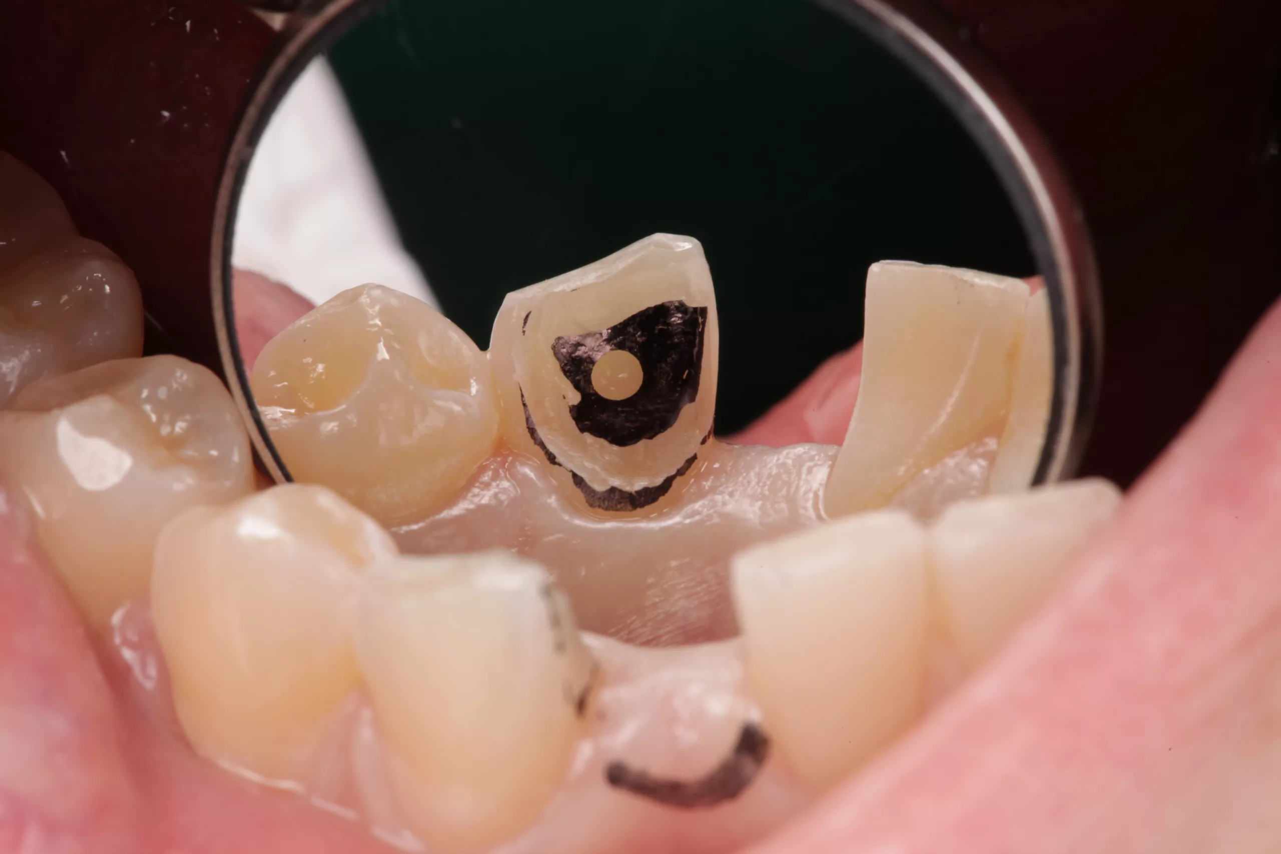 Patientenfall: die adhäsive Versorgung der Einzelzahnlücke | Dentalwelt
