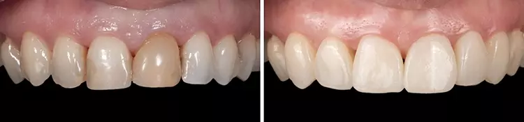 Der Fall der Gewinnerin Margherita Feliciotti: Wiederherstellung der Frontzahnästhetik (regio 13 bis 23) mit Kompositrestaurationen nach internem Bleichen des Zahnes 21. Das klinische Ergebnis zeigt ein deutlich verbessertes Erscheinungsbild.