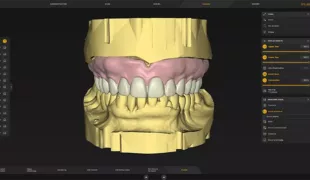 Die inLab Software 22.0 erweitert ihren Anwendungsbereich im Labor, wie etwa das digitale Prothesendesign auf Einzelkiefern (14er).