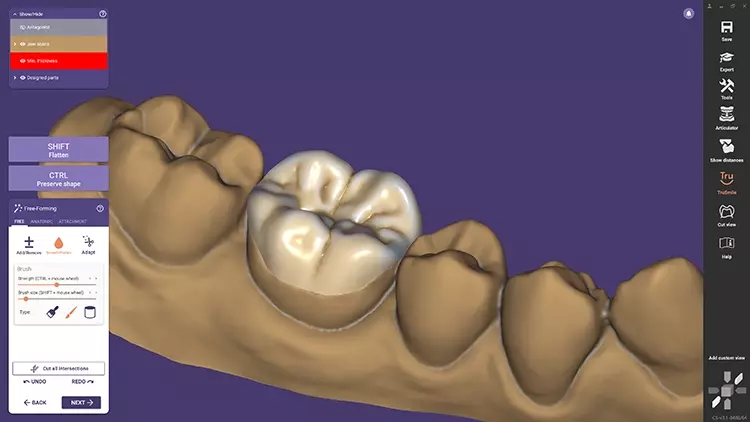 Mit ChairsideCAD 3.1 Rijeka können Anwender nun 3/4-/Overlay-Kronen-Designs erzeugen und Restaurationen auf konfektionierten Abutments designen.