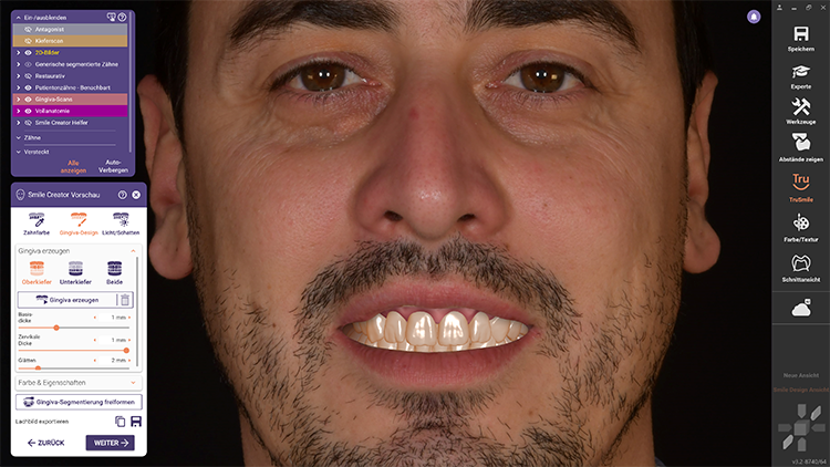 Abb. 3 Dank der Zahnsegmentierung können auch die Gingiva und die Nachbarzähne visualisiert werden, um ein einheitliches Bild der neuen Aufstellung im Patientenmund zu erhalten. Im Seitenzahnbereich wird der natürliche Schatten in der Mundhöhle simuliert.