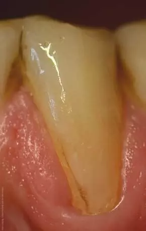 Klasse-V-Kompositrestauration 
an Zahn 33 mit verfärbtem Rand nach 
fünf Jahren Liegedauer.