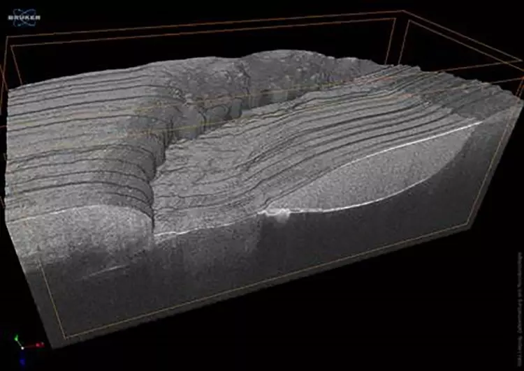 OCT-3D-Volumenbilderstapel der Klasse-V-Komposit-
restauration des Zahnes 33.