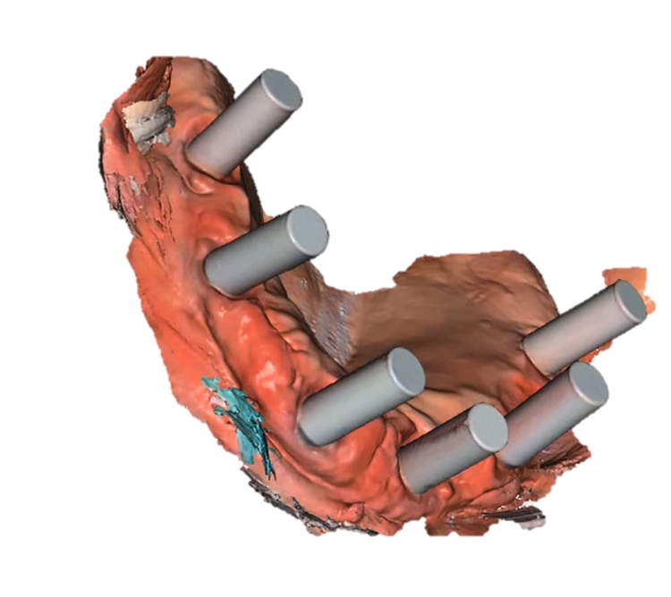 Primescan ist der erste und einzige Intraoralscanner, der für den kompletten digitalen Workflow für festsitzende Ganzkiefer-Implantatversorgungen mit Atlantis Suprastructures validiert ist.