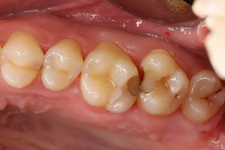 Abb. 1: Die Defekte mit Sekundärkaries an den Zähnen 26 odp und Zahn 27 mo
führten bei einem 31-jährigen Patienten zur Retention von Speiseresten und zu
einem unangenehmen Geschmack, jedoch nicht zu Schmerzen.