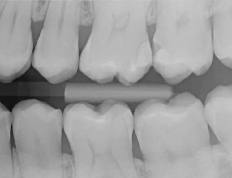 Abb. 2: Das Röntgenbild bestätigt die klinischen Befunde im 2. Quadranten.
Zusätzlich waren Aufhellungen an den Zähnen 37 mesial und 36 distal
auszumachen, die jeweils auf eine Approximalkaries schließen ließen (C2 =
Karies bis in die innere Schmelzhälfte).