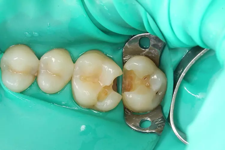 Abb. 3: Die insuffizienten Füllungen und Sekundärkaries wurden entfernt und
die Kavitäten präpariert. Nach Glättung der Kavitätenränder wurden die zu
behandelnden Zähne mit Kofferdam isoliert.