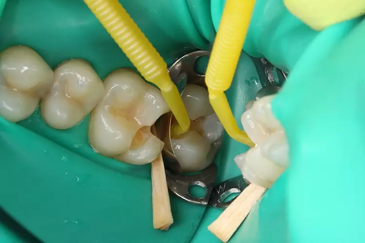 Abb. 4: Ein Teilmatrizenband wurde adaptiert und verkeilt. Nach selektiver Schmelzätzung
wurde zunächst ein Universaladhäsiv (Futurabond U, VOCO) appliziert.
Beim Verblasen wurde die noch unversorgte Nachbarkavität (Zahn 26) mit Teflonband
aufgefüllt, damit kein Bonding in die Kavität des Zahnes 26 gelangt (nicht
auf dem Foto abgebildet). Anschließend wird ein fließfähiges Nanohybrid-Ormocer
(Admira Fusion Flow, VOCO) appliziert.