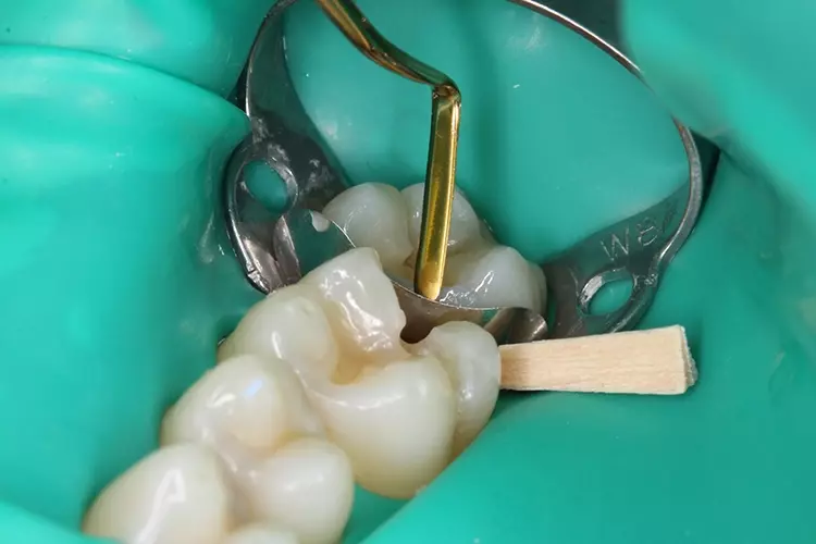 Abb. 5: Die Randleiste an Zahn 27 wurde mit einem hochviskösen Nanohybrid-Bulk-Fill-Komposit (GrandioSO x-tra, VOCO) aufgebaut. Die Modellation der
abgerundeten Randleiste gelang mit einem leicht elastischen Modellierspatel.