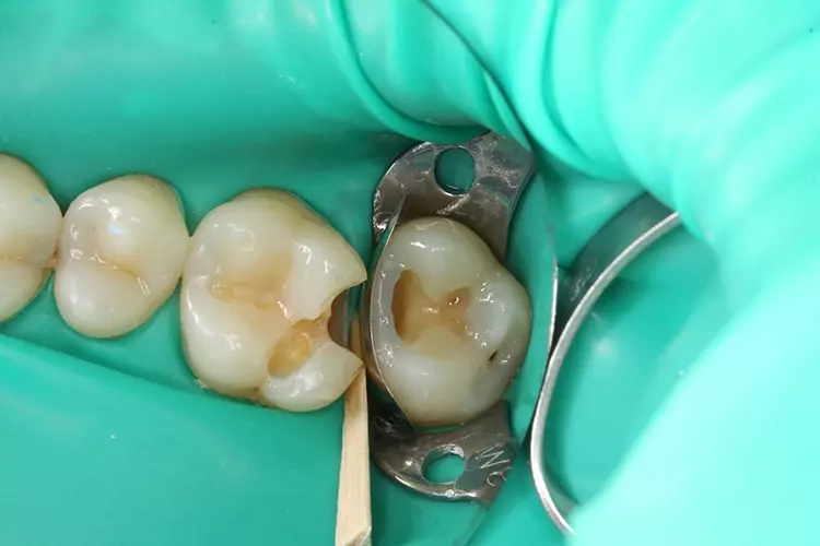 Abb. 6: Die Randleiste an Zahn 27 wurde mit einem hochviskösen Nanohybrid-Bulk-Fill-Komposit (GrandioSO x-tra, VOCO) aufgebaut. Die Modellation der
abgerundeten Randleiste gelang mit einem leicht elastischen Modellierspatel.