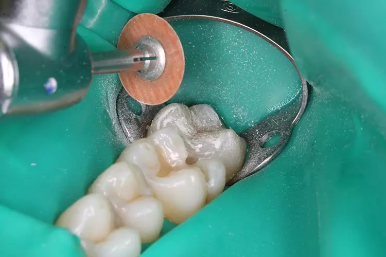 Abb. 7: Ebenfalls mit dem Bulk-Fill-Komposit wurden die bukkalen und palatinalen Höckerabhänge schrittweise modelliert. Vor dem Einbringen der nächsten Matrize wurde die Füllung noch ausgearbeitet und poliert.