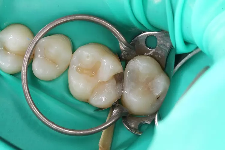 Abb. 8: Distal von Zahn 26 wurden eine Teilmatrize verkeilt und ein Spannring eingesetzt. Auf dem Foto: Der distopalatinale Höckerabhang und die approximale Wand bis zum Kavitätenboden konnten selektiver Schmelzätzung und Applikation von Futurabond U (VOCO) aufgebaut werden.