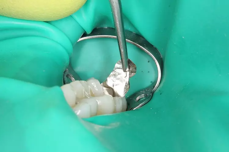 Abb. 9: Die Matrize konnte nur gegen einen Abzugswiderstand aus dem Approximalraum entfernt werden – ein Hinweis auf einen suffizienten Kontaktpunkt.